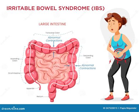 Ibs Symptoms. Irritable Bowel Syndrome Infographic, Stomach Digestive Disease Symptom Diarrhea ...