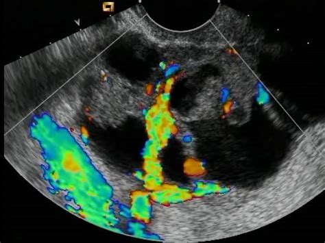 Ovarian Cancer Transabdominal Ultrasound Ovarian Cysts