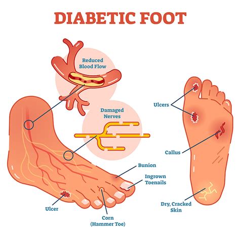 Diabetic Foot Care at the SCMSC | Call 818-900-6480