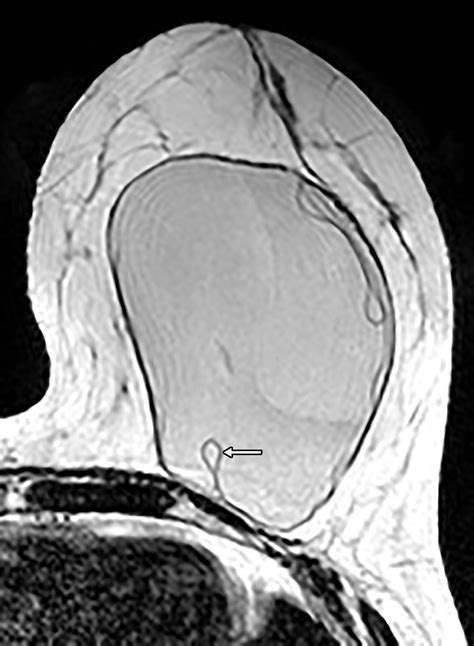 Multimodality Imaging-based Evaluation of Single-Lumen Silicone Breast Implants for ...