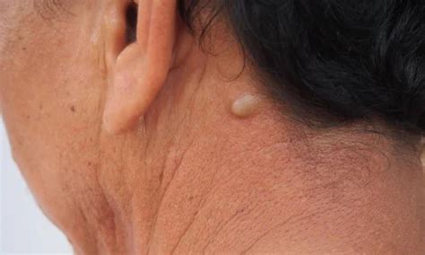 Sebaceous Cyst Removal: Procedure & Recovery - CK Birla Hospital