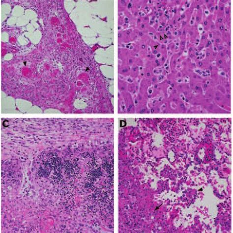 Photomicrograph of a smear of mucopurulent nasal discharge from a ...