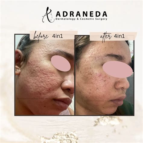 adraneda.derm | Acne Scars | Dermatology | Cosmetic Surgery | After 1 session of 4in1 ...