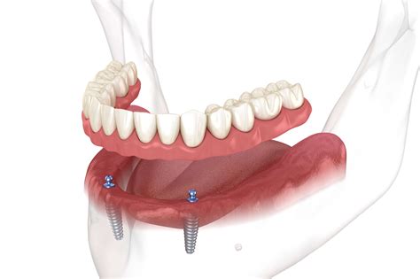 When to prescribe implant supported vs implant retained dentures | Dandy