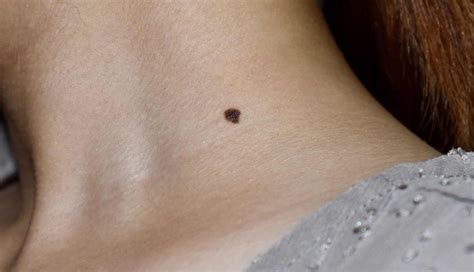 9 Things To Keep in Mind For Moles - lifeberrys.com