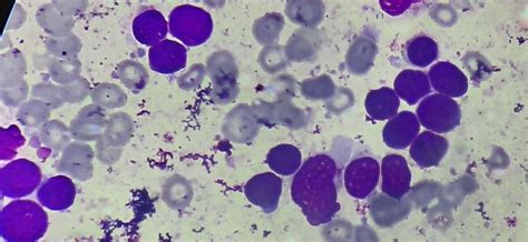 Acute Lymphoblastic Leukemia/ Lymphoma - howitreat.in