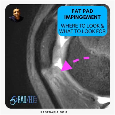 KNEE MRI FAT PAD IMPINGEMENT: WHERE TO LOOK & WHAT TO LOOK FOR ...
