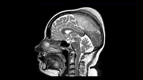 Brain And Spinal Cord Tumors Definition - Infoupdate.org