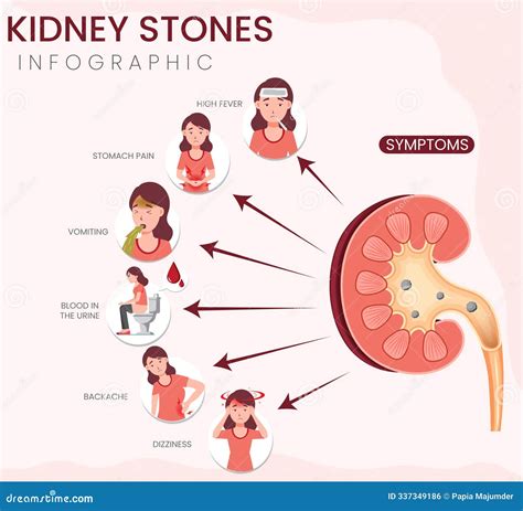 Kidney Stones Symptoms Infographic Identifying Pain, Nausea, And ...