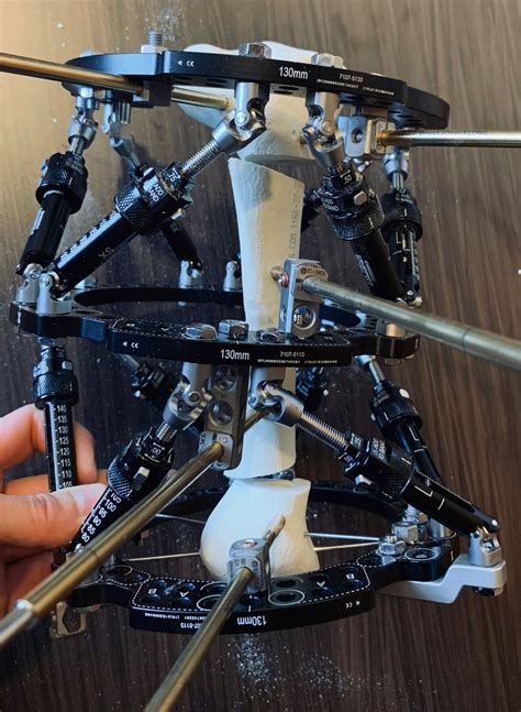 Deformitätenkorrektur mit computergestütztem Hexapoden-Fixateur ...