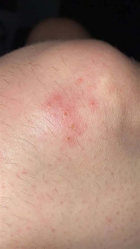 Is This a Yellow Sac Spider Bite? : r/medical_advice