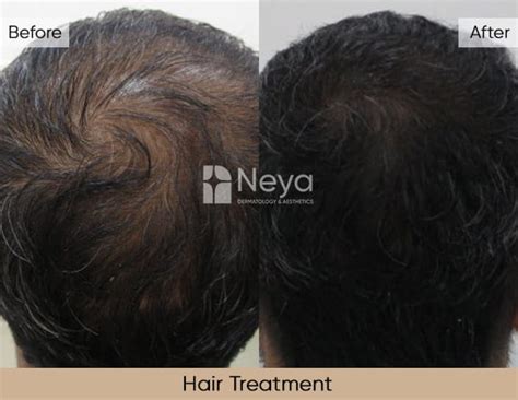 GFC Treatment in Hyderabad | Dr. Ravali Yalamanchili