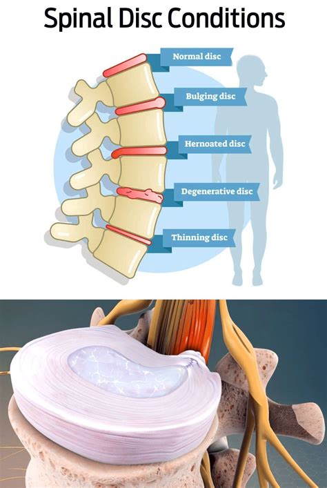 Bulging Disc Surgery 的图像结果