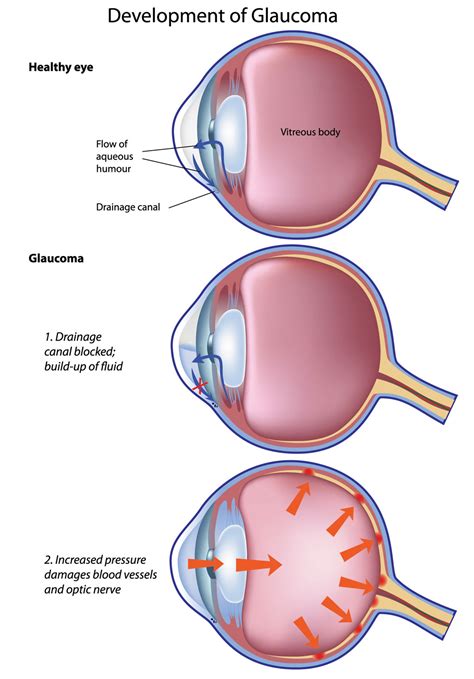 Glaucoma Treatments - Glaucoma Associates of Texas