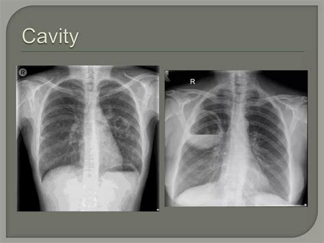 Bullous disease of lung.pptx