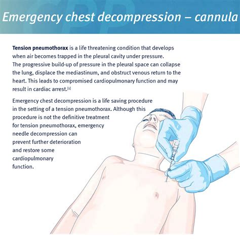 Tension Pneumothorax Needle Decompression
