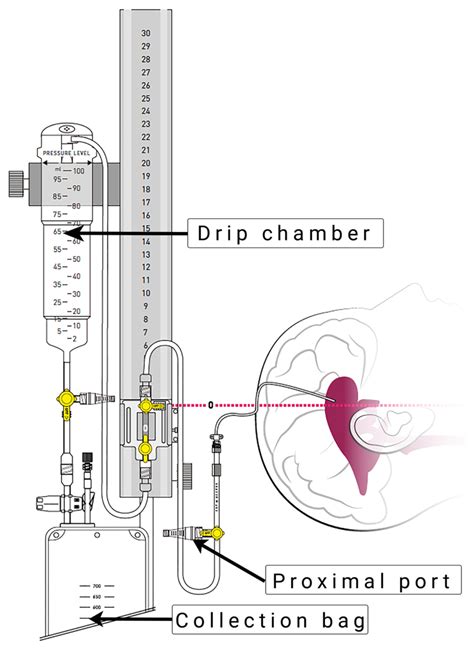Where to Draw Cerebrospinal Fluid from an External Ventricular Drain ...