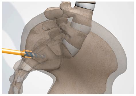 Minimally Invasive Postero-Inferior Sacroiliac Joint Fusion: Surgical Technique and Procedural ...