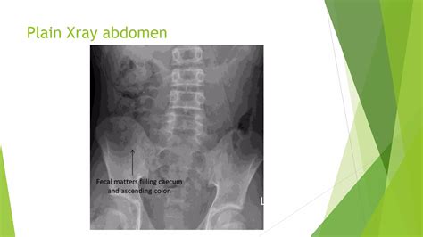 Approach to right iliac fossa(RIF) pain | PPTX