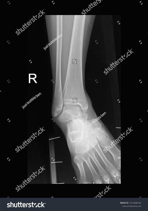 Fractured Ankle X Ray