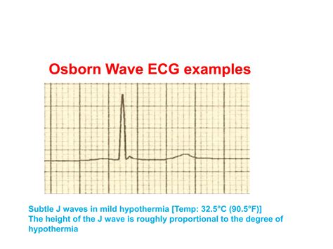 J Wave Ecg