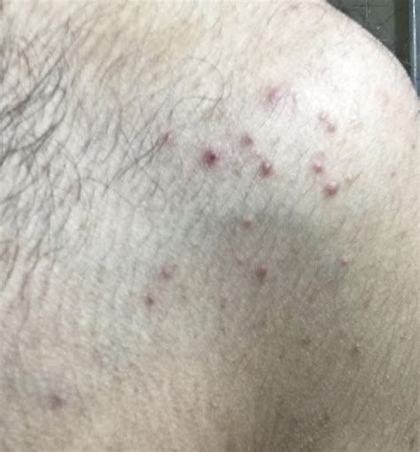 I tried the ink test... Does it look like a scabies burrow? : r/scabies