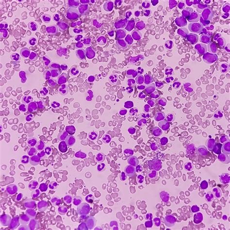 APL à haut risque: nouveau traitement de référence? – CML: asciminib p ...