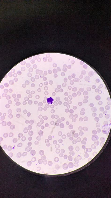 Plasma cell Leukaemia : r/Hematology