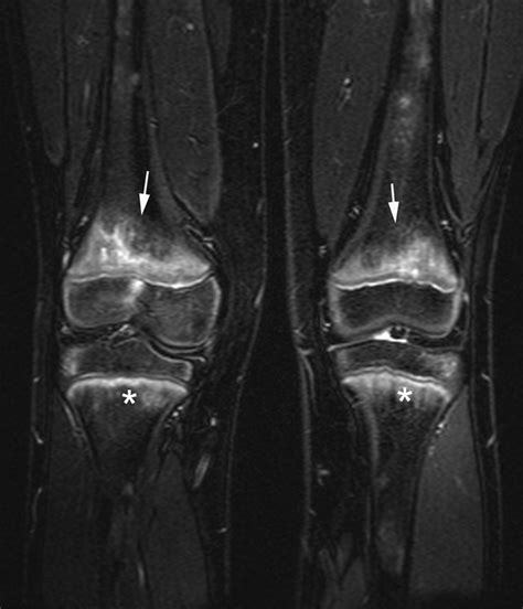 Chronic Multifocal Osteomyelitis