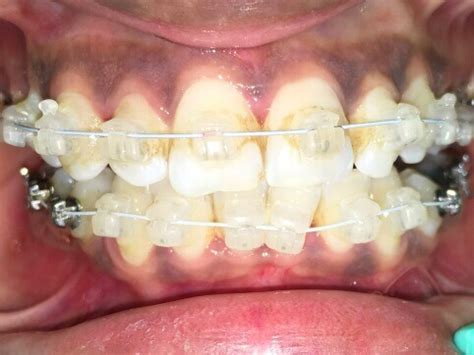 Orthodontist in Ahmedabad, Braces Treatment Cost in Ahmedabad