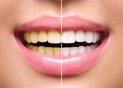 Your Guide to How Teeth Stains Happen