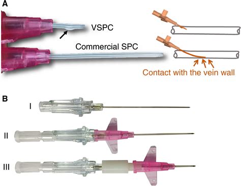 Novel short peripheral catheter design for prevention of thrombophlebitis - Journal of ...