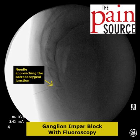 Ganglion Impar Block with Fluoroscopy - The Pain Source - Makes ...
