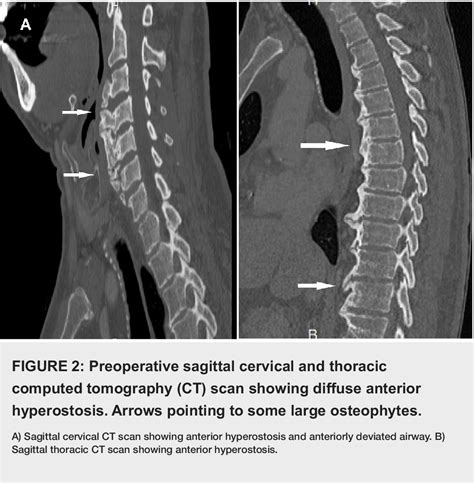 Cervical Osteophytes