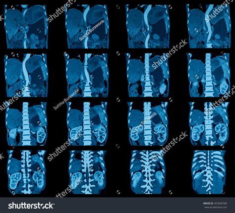 Ct Scan For Abdominal Pain