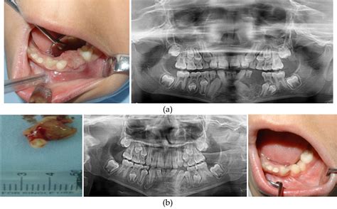 X Ray Pictures Of Jaw Bone Cancer at Eileen Towner blog