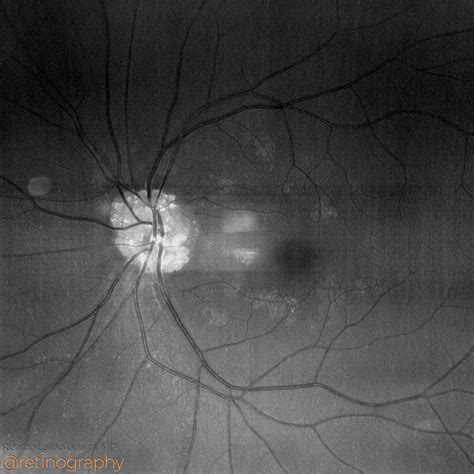Optic disc drusen – Retinography