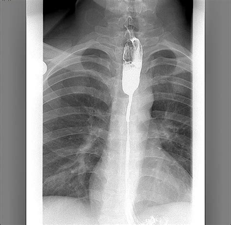 Image result for Modified Barium Swallow Study Basic