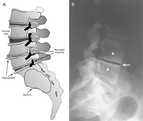 Osteophytes Lumbar