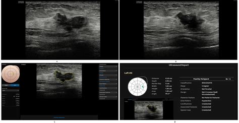 Diagnostic performance of ultrasound with computer-aided diagnostic system in detecting breast ...