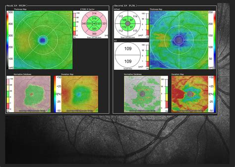 Optical Coherence Tomography | Luna