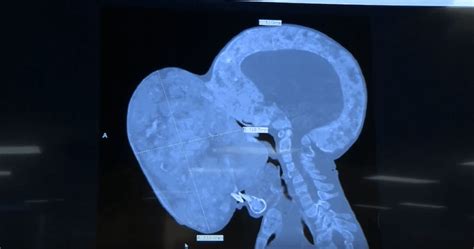 Teenager with a basketball-size tumour on his face awaits life-saving ...
