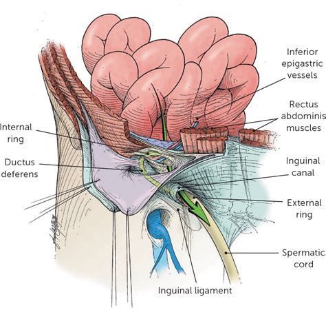 Inguinal Hernia Pictures