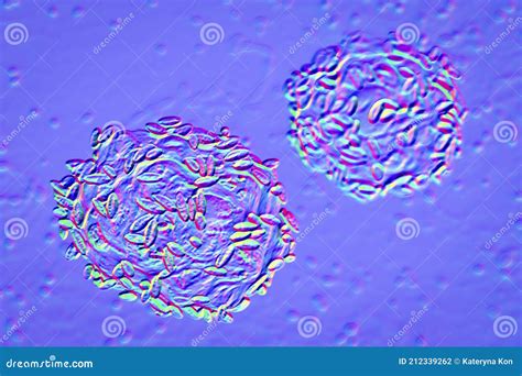 Bacterial Vaginosis, Illustration Stock Illustration - Illustration of ...