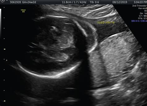 Antenatal Management of Second Trimester Oligohydramnios and Evolving ...