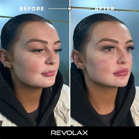 Lip Filler Before and After Photos and Results - the daily glimmer