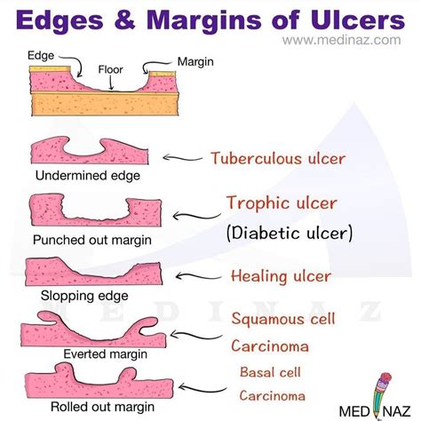 Ulcers Definition