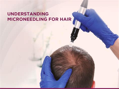 Microneedling for Hair: What to Expect During and After Treatment - Skin Solutionz