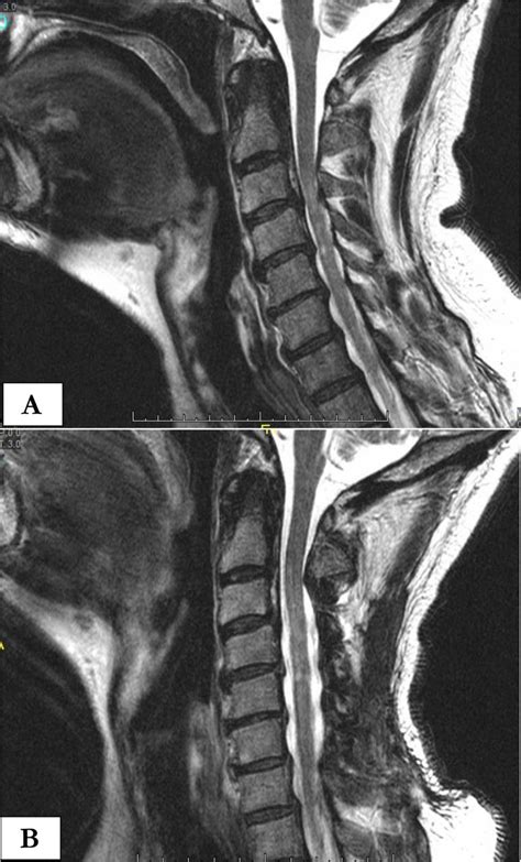 Regression of Disc-Osteophyte Complexes Following Laminoplasty Versus ...