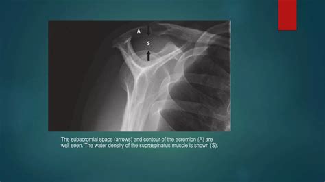Acromioclavicular joint arthritis | PPTX